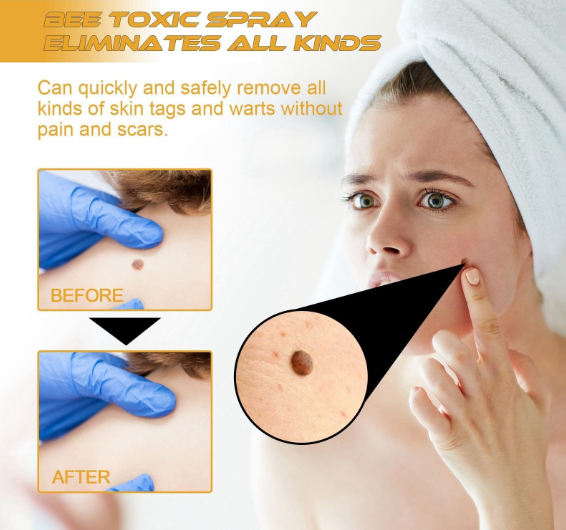 TECNOFEX Bee Venom Skin Tag Removal Cream Spray