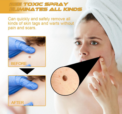 TECNOFEX Bee Venom Skin Tag Removal Cream Spray